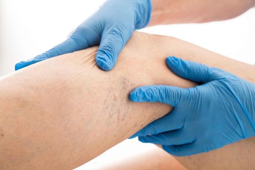 Clinical disease with varicose