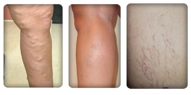 The phases of varicose veins