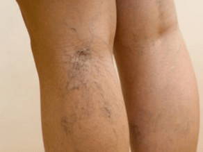 The second phase of varicose veins