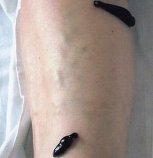 Hirudotherapy as a varicose vein treatment method