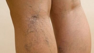 The causes of varicose veins