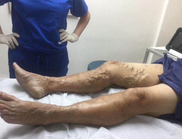 The consequences of not treating varicose veins