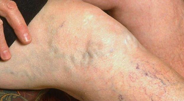 Visible symptoms of varicose veins in the legs