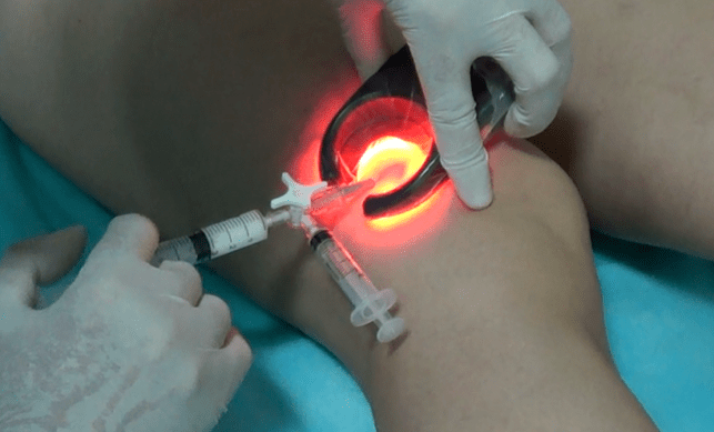 Sclerotherapy is an effective method for treating varicose veins in the legs