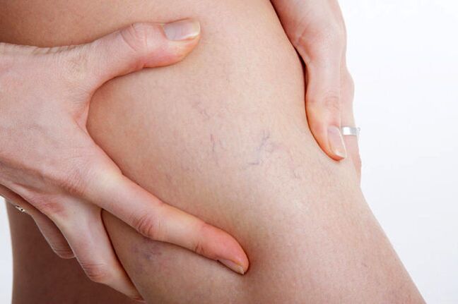 The first appearance of varicose veins in the legs